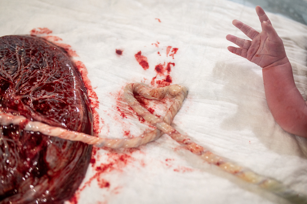 Plazenta verkauft bei Kaiserschnitt